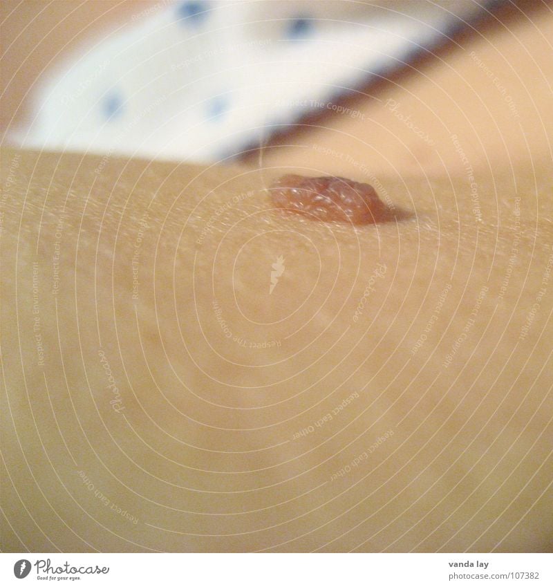 Hautkrebs? Mole dreidimensional Unterhose Makel Leberfleck Makroaufnahme Nahaufnahme Angst Panik skin Krebstier cancer birthmark mother's mark wart
