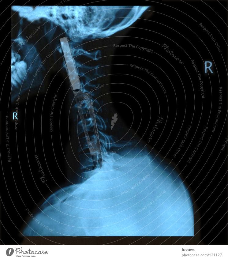 Freak Gesundheit Krankheit Unfall trinken Skelett Patient Gesundheitswesen Lunge Arzt Chirurg Diagnostik durchsichtig Anatomie Wirbelsäule Operation Röntgenbild
