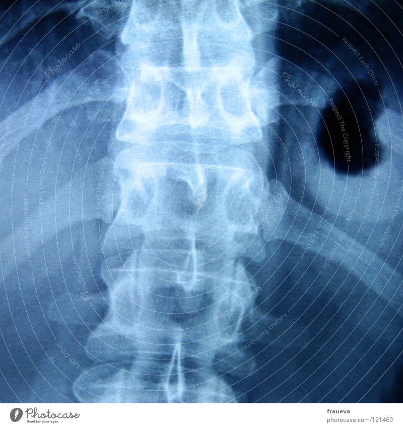 schwarzes herz Wirbelsäule Rippen Krankheit Arzt Gesundheitswesen Röntgenbild durchleuchtet Wissenschaften Fleck blau Diagnostik Radiologie