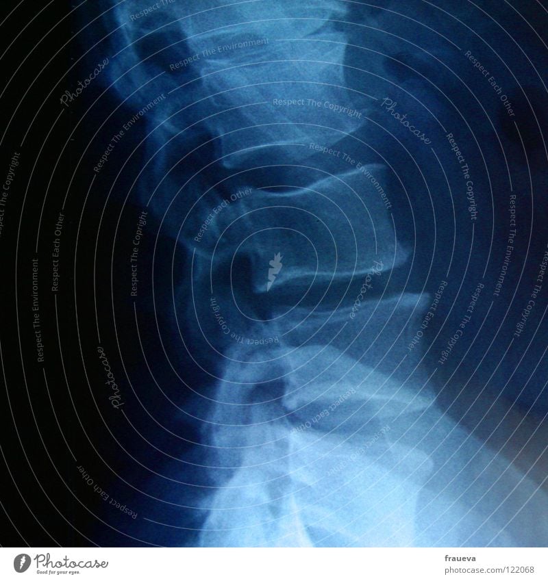 hals Wirbelsäule Rippen Krankheit Arzt Gesundheitswesen Röntgenbild durchleuchtet Skelett Hals blau Diagnostik Radiologie