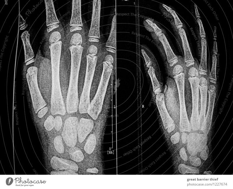 Skeletthände Röntgenbild Mensch maskulin Junge Hand Finger 3-8 Jahre Kind Kindheit authentisch gruselig schwarz weiß Schwarzweißfoto Innenaufnahme Nahaufnahme