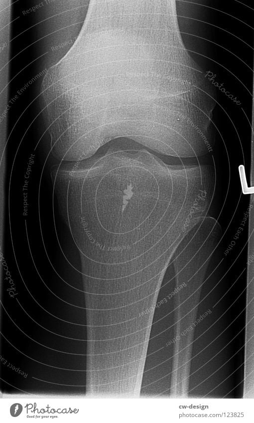 GHOST Röntgenbild Röntgenstrahlen Skelett Oberschenkel Unterschenkel Schienbein Gelenk Kniescheibe Sprunggelenk Arthrose Fraktur Krankheit links Sturz schwarz