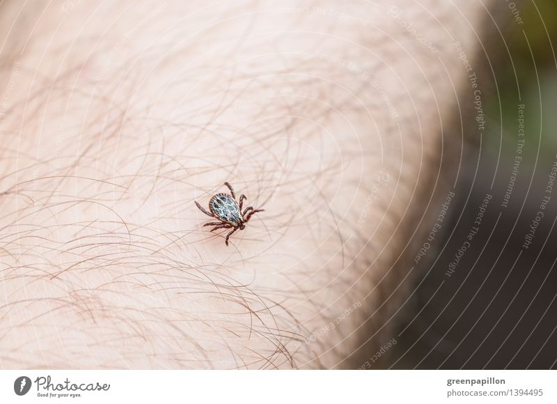 Zecke auf der Haut Parasit Blutsauger Borreliose FSME Insekt Krankheitserreger Lyme-Borreliose Infektionsgefahr Gefahr Überträger Biss Milben Natur Sommer Wald