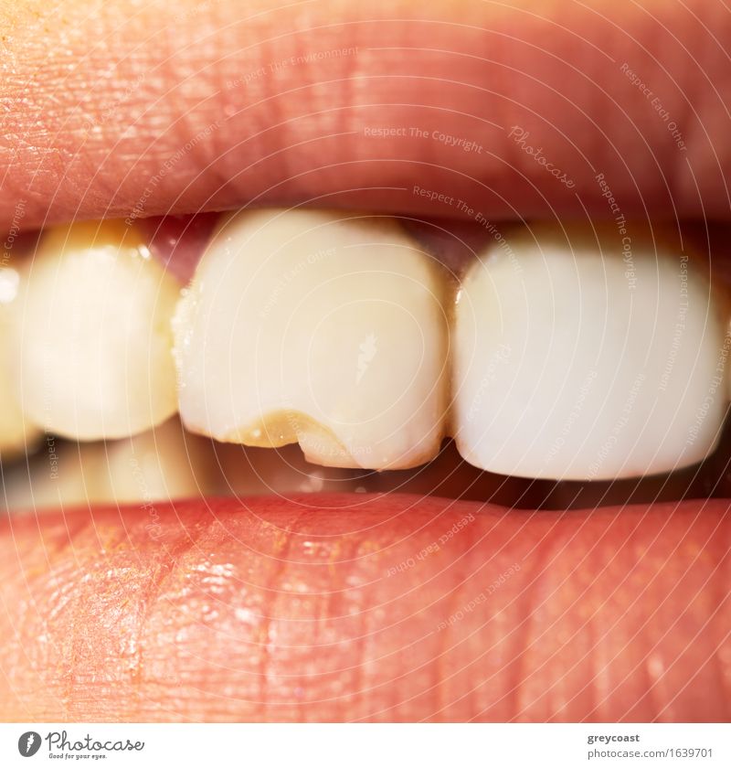 Makroaufnahme des abgebrochenen Spaltzahns. Gesundheitswesen Behandlung Prüfung & Examen Beruf Mensch Mund Lippen Zähne 1 Ekel Sauberkeit gelb weiß Schaden