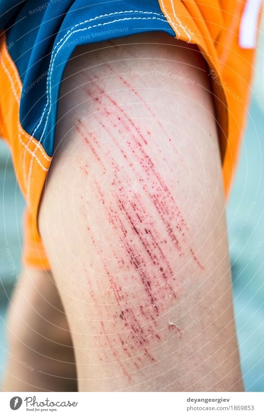 Bruise Wunde am Bein des Kindes Haut Medikament Mensch Junge Kindheit Arme rot weiß Schmerz blaue Flecken Knie zerkratzen Unfall Blut Gesundheit verletzt wehtun