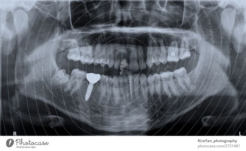 Röntgenzähne Ober- und Unterkiefer Medikament Mensch Mund Zähne blau Weisheit Radiologie dental Rochen Platzhalter enossal Kiefer Medizin Implantat Chirurgie