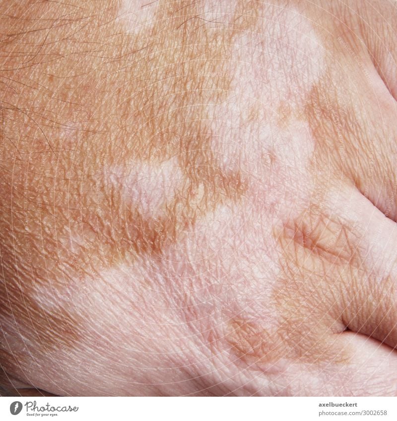 Vitiligo oder Weißfleckenkrankheit Gesundheitswesen Mensch maskulin Mann Erwachsene Haut Hand 1 30-45 Jahre Krankheit weiß Patient scheckhaut