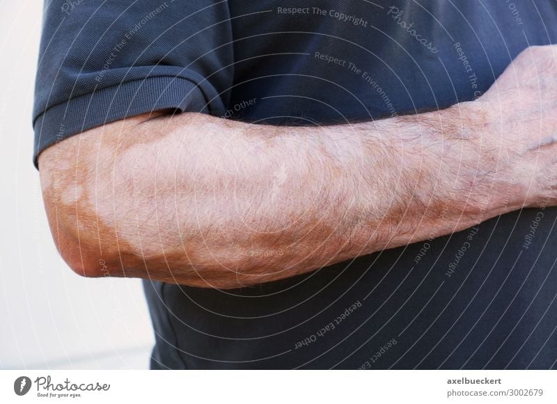 Vitiligo oder Weißfleckenkrankheit oder Scheckhaut Gesundheitswesen Mensch maskulin Mann Erwachsene Haut Arme Hand 1 45-60 Jahre Krankheit weiß