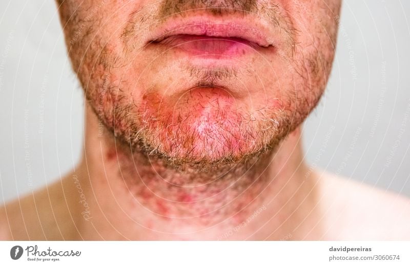 Mann mit seborrhoischer Dermatitis im Bartbereich Haut Gesicht Behandlung Krankheit Allergie Medikament Mensch Erwachsene Vollbart authentisch rot Irritation