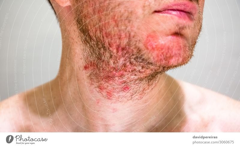Mann mit seborrhoischer Dermatitis im Bartbereich Haut Gesicht Behandlung Krankheit Allergie Medikament Mensch Erwachsene Vollbart authentisch rot Irritation
