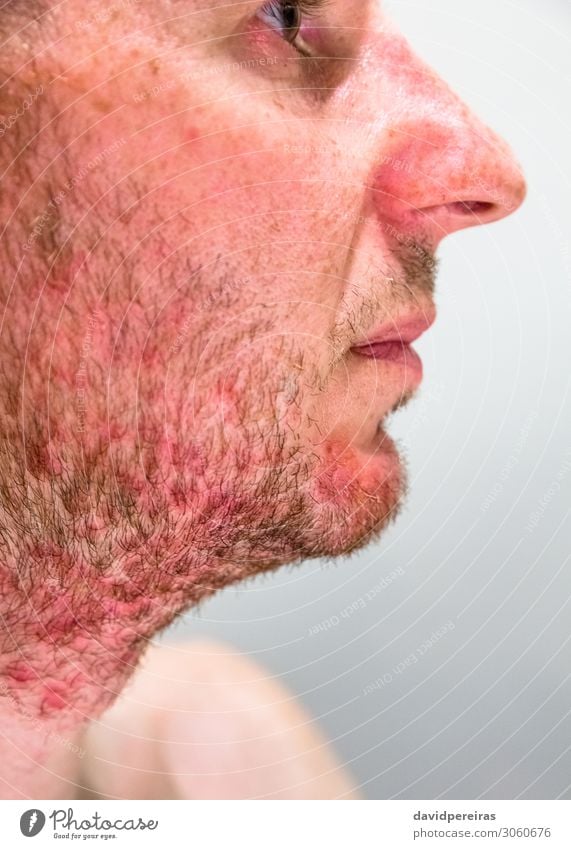 Kinn eines Mannes mit seborrhoischer Dermatitis im Bart Haut Gesicht Behandlung Krankheit Allergie Medikament Mensch Erwachsene Vollbart authentisch rot