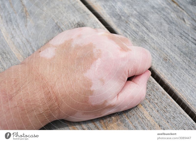 Vitiligo oder Weißfleckenkrankheit Gesundheit Gesundheitswesen Krankheit Mensch maskulin Mann Erwachsene Hand 1 18-30 Jahre Jugendliche 30-45 Jahre weiß