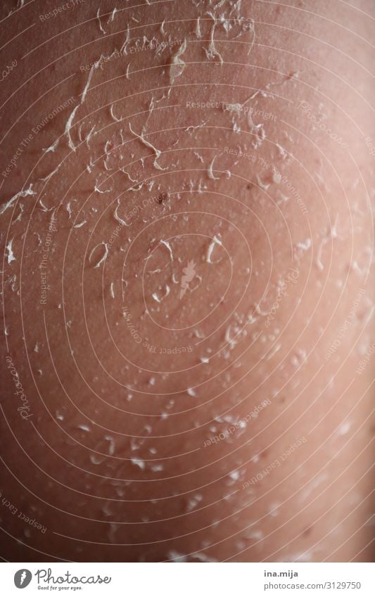 Haut schält sich schön Körperpflege Gesundheit Behandlung Krankheit Allergie Kur Gesundheitswesen Dermatologie Sonnenstrahlen Sonnenbrand UV-Strahlung
