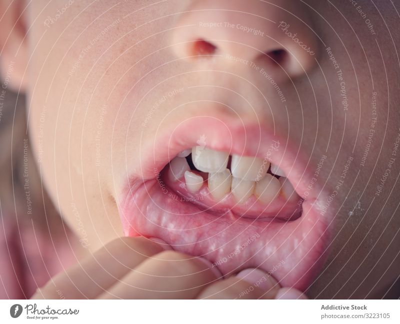 Offener Mund eines Kindes voller bleibender und Milchzähne Zahn Kindheit mündlich melken dental Lächeln offen Gesicht zeigend Ausdruck kieferorthopädisch