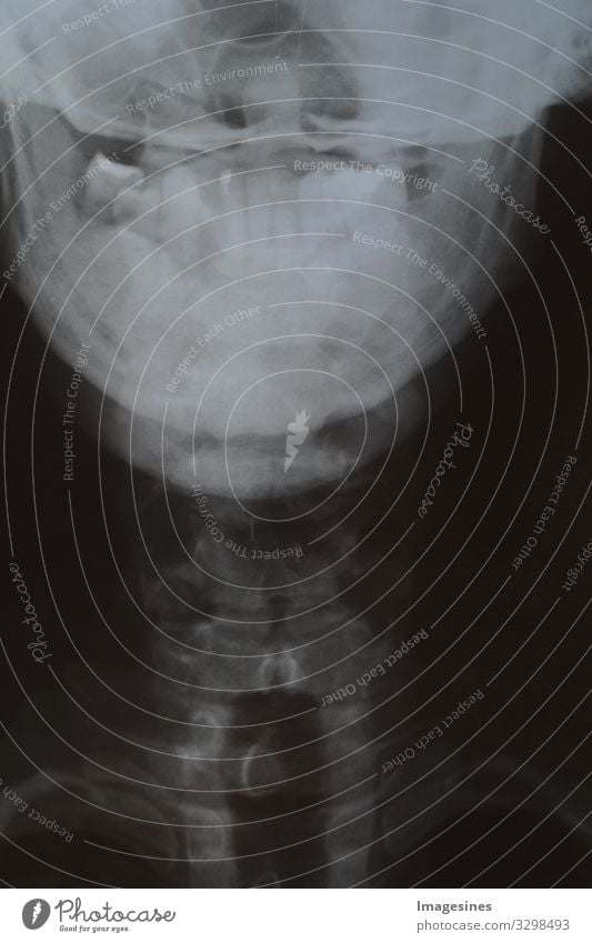 kranke Zähne - Röntgenbild von menschlichem Kopf und Kiefer mit wenigen Zähnen. Röntgen Aufnahme der Zähne. Zahn Röntgenfilm, Knochenverlust, Patient mit herausnehmbarem Zahnersatz.
