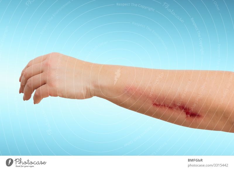 Schürfwunde Unterarm Gesundheit Gesundheitswesen Behandlung Mensch feminin Junge Frau Jugendliche Erwachsene Körper Arme Hand 1 30-45 Jahre Missgeschick Rettung