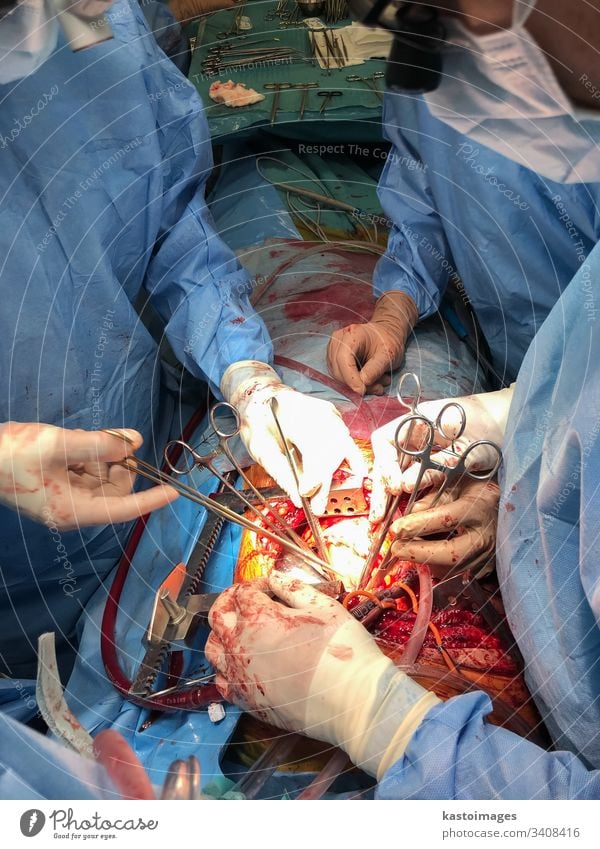 Chirurgenteam, das die medizinische Operation der Organtransplantation durchführt. Chirurgie Medizin in Betrieb befindlich Transplantation Krankenhaus Arzt