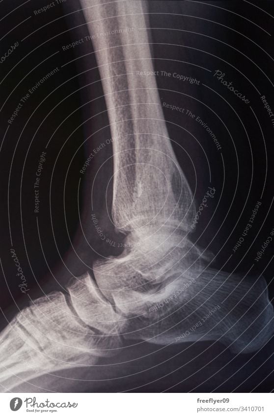 Knochenscan eines Fußes Scan röntgen Röntgenaufnahme Medizin Krankenhaus Fraktur Verletzung Rehabilitation Strahlung Tomographie Krankheit Radiologie Gelenk