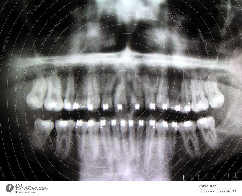 Blechfresse schwarz Reparatur Mann Kiefer Metall Kieferorthopädie wiß Zähne Radiologie