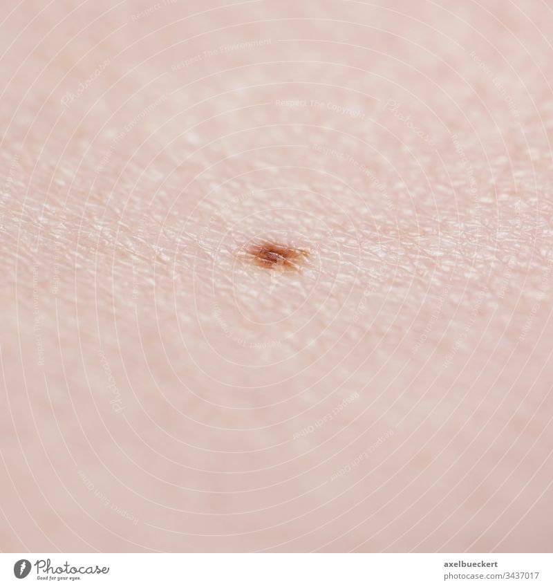 Haut mit Muttermal Leberfleck Dermatologie Nävus Schönheitsfleck melanozytär Melanozyten klein Nahaufnahme Makro Melanom menschlich Krebs medizinisch gutartig