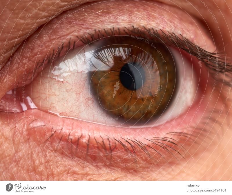 offenes Auge eines Mannes mit roten Gefäßen, allergische Reaktion des Körpers infiziert schließen Krankheit Sehvermögen Infektion krank Verletzung Makro