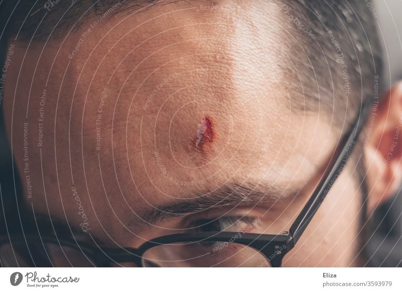 Ein verletzter Mann mit einer Wunde an der Stirn Verletzung Kopf Beule Schmerz Unfall Blut Brille schmerzhaft offen Haut wehtun Nahaufnahme Mensch Heilung