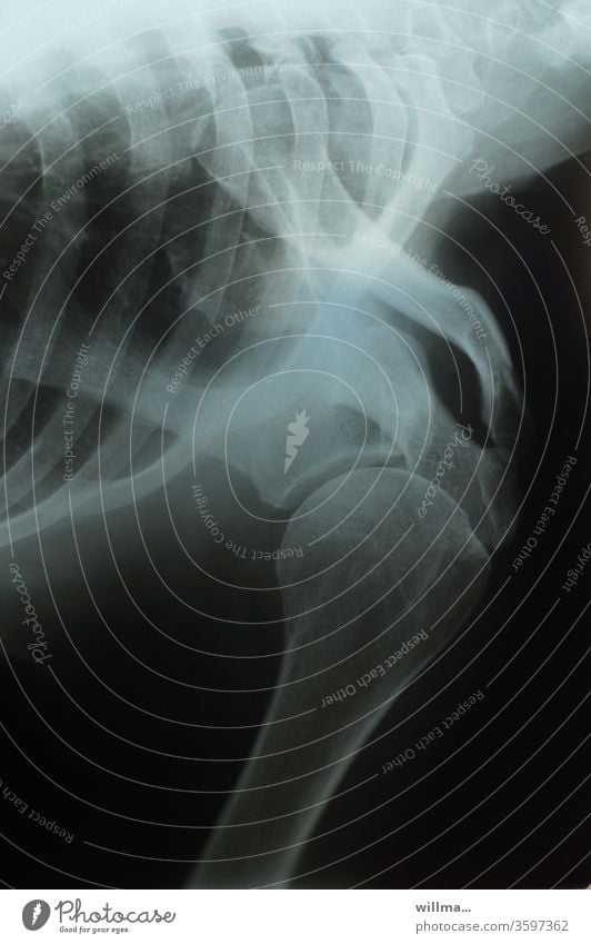 Röntgenbild Schultergelenk und Thorax mit Rippen Radiologie Knochen Röntgendiagnostik Gelenk Gesundheitswesen Diagnostik Skelett