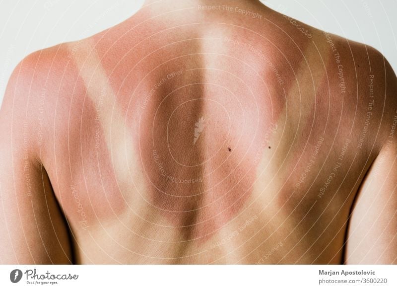 Nahaufnahme eines Sonnenbrandflecks auf dem Rücken einer Frau Detailaufnahme Grundriss Spuren Menschen vereinzelt ultraviolett Sonnenlicht Bräunen Schönheit