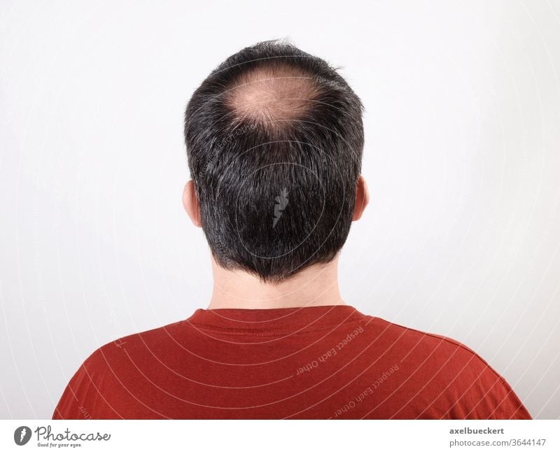 Haarausfall Androgenetischer Haarausfall Alopezie Haare kahle Stelle Oberkopf Tonsur Hinterkopf Mann Kopf Alterung Kahlheit anonym Gesundheit Erwachsener