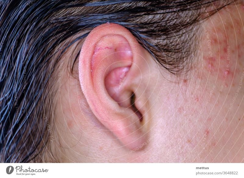Akne auf der Gesichtshaut in der Nähe des Ohrmakrobildes. Männliche Gesichtshaut mit Entzündungen. Ohr eines Jungen im Teenageralter menschlich Haut Teint Typ
