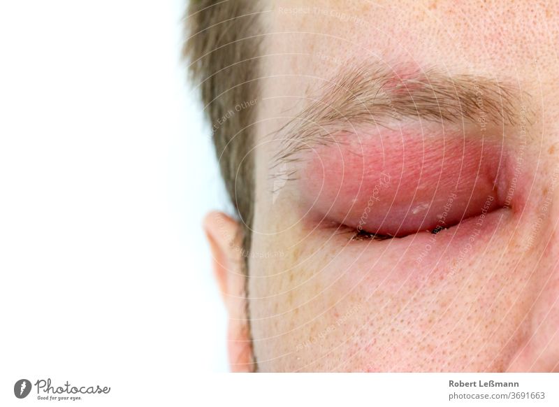 ein Mann mit einem durch einen Bienenstich geschwollenen Auge Gesicht Wespenstich Ödem angeschwollen Verletzung rot Allergie Schwellung gestochen Augenlid