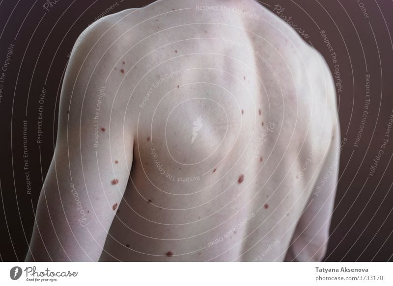 Männlicher Torso mit vielen Muttermalen, Körper Gesundheit Leberfleck Rücken Dermatologie Haut medizinisch Melanom Pflege Fleck Krankheit nackt menschlich