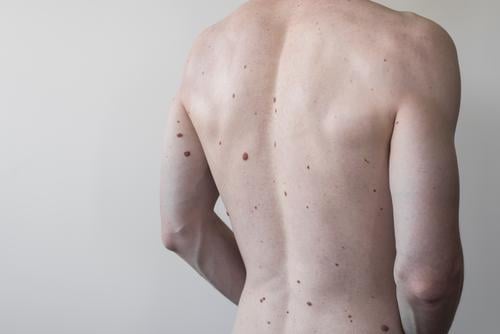 Männlicher Torso mit vielen Muttermalen, Körper Gesundheit Leberfleck Rücken Dermatologie Haut medizinisch Melanom Pflege Fleck Krankheit nackt menschlich