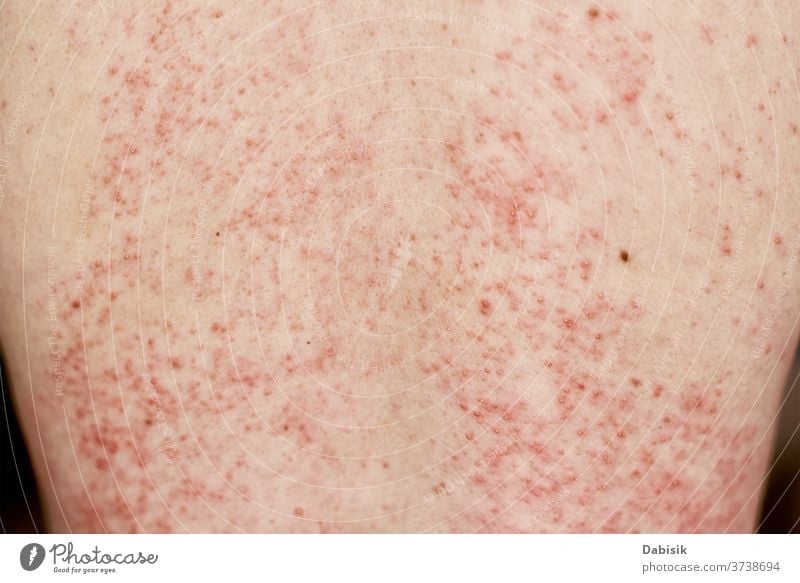 Allergischer Ausschlag auf der Haut. Frau mit dermatologischem Problem auf der Rückenhaut überstürzt Allergie Hautausschlag Dermatologie Infektion Krankheit