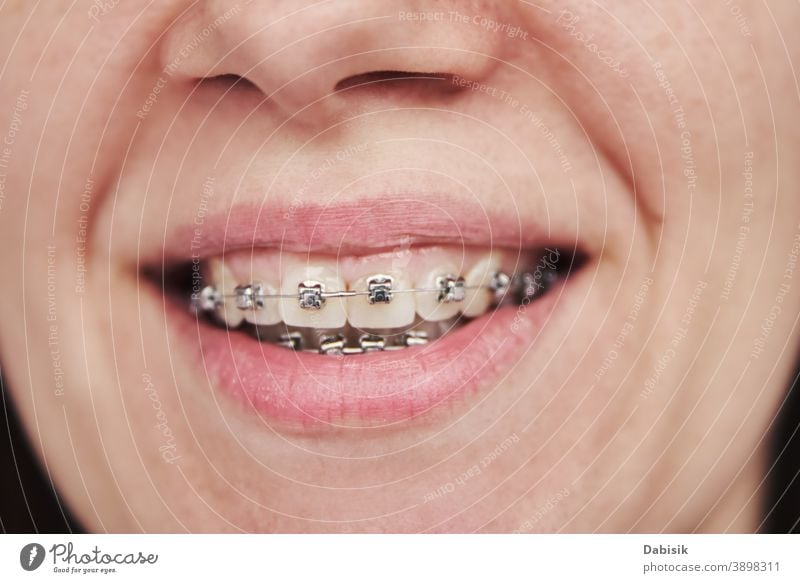 Frau mit Zahnspange, Nahaufnahme kieferorthopädisch dental Klammer Halterung Zahnarzt Zähne Lächeln Behandlung Schönheit Mund Gesundheit schön Pflege Lippen