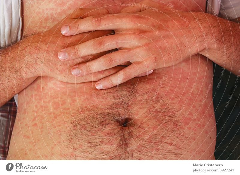 Masern oder Rubeola-Ausschlag auf der Haut eines kaukasischen Mannes Masernausschlag Masernerkrankung Kaukasier männlich medizinisch Hauterkrankung Symptome
