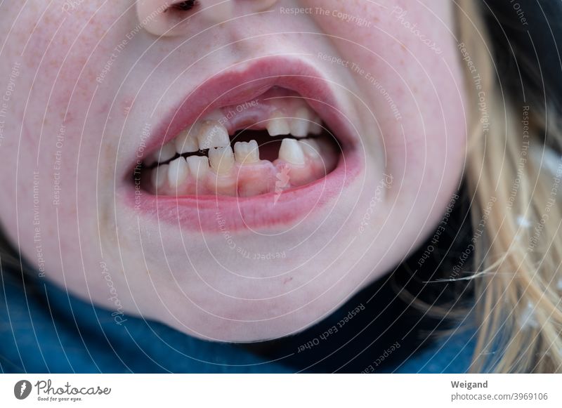 Milchzähne Lücke Zähne Gebiss Zahnarzt Kind Kindheit wachsen fehlen wenig Defizit