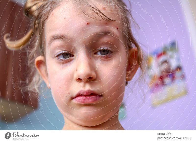 Porträt eines Kindes, dessen Haut mit Windpocken infiziert ist Schmerzen Bakterien Blasen Schaumblase Pflege Kaukasier ansteckend weinen Dermatologie Krankheit