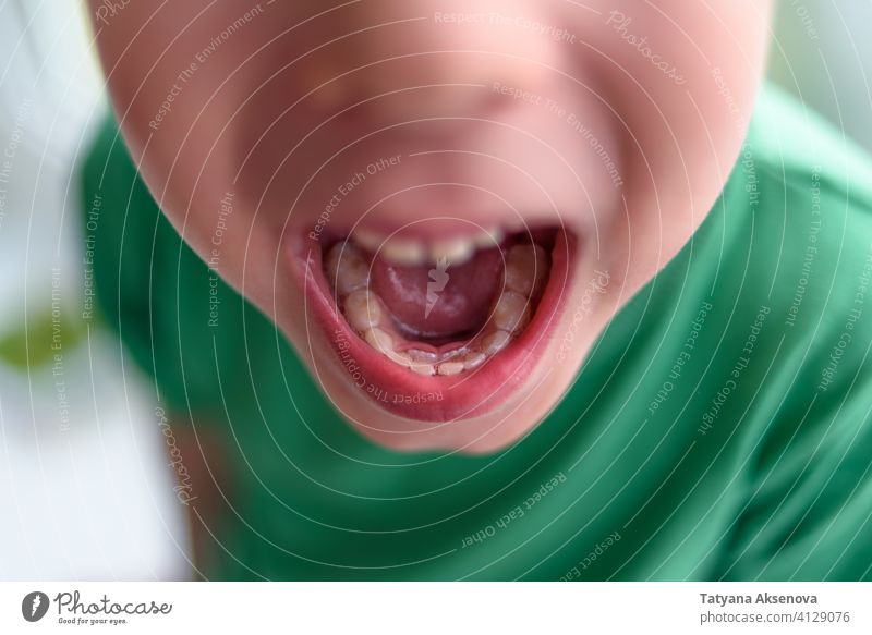 Junge mit zweiter Zahnreihe melken Kind dental Mund offen kieferorthopädisch dauerhaft primär Wandel & Veränderung Reihe Problematik Gesundheit jung Zahnarzt