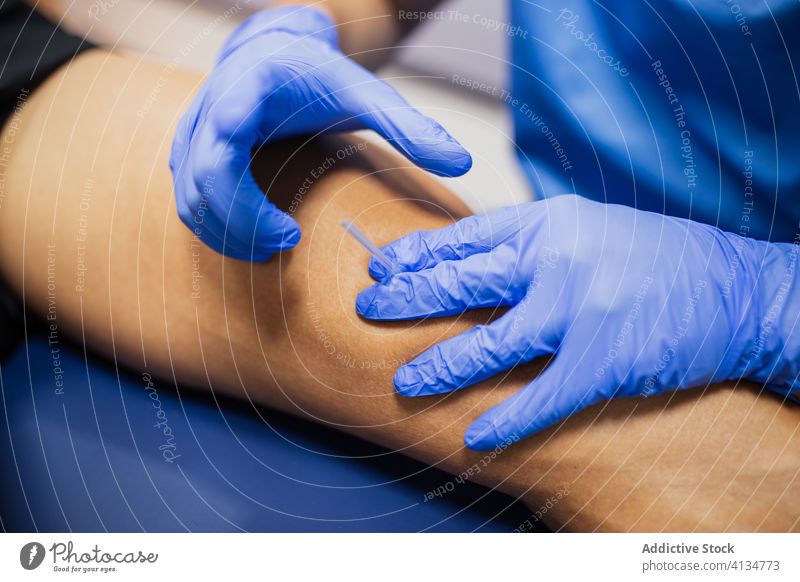 Unkenntlich gemachter Arzt führt Nadel in das Bein eines anonymen Sportlers ein einstecken geduldig Akupunktur Behandlung Verfahren steril Handschuh