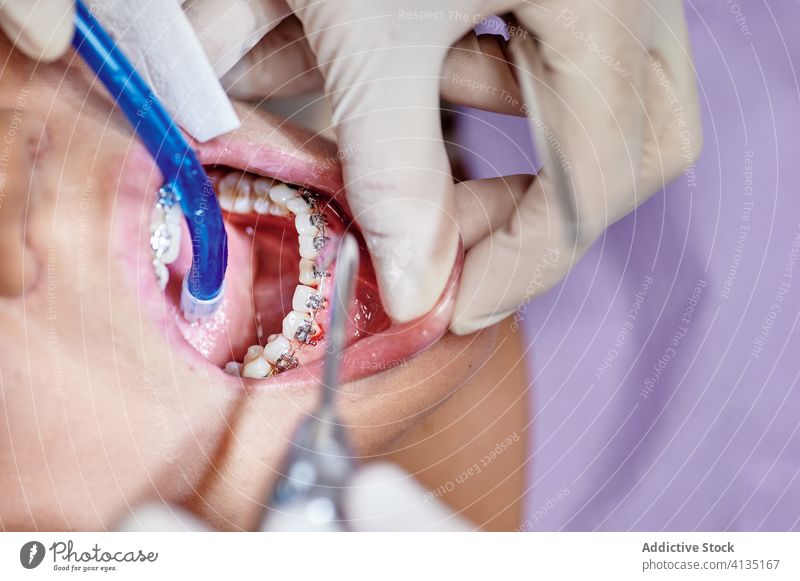 Pflanzenzahnarzt prüft Zahnspange des Patienten geduldig dental Pflege Sauberkeit Krankenhaus Verfahren Gerät mündlich Leckerbissen Instrument Medizin