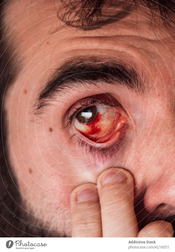 Mann mit blutunterlaufenem Auge schaut in die Kamera rot Vene entzünden verärgern Infektion krank Verletzung männlich entzündet ungesund Problematik Symptom
