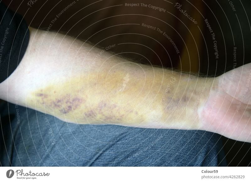Allergie am Arm Haut Krankheit Gesundheit medizinisch Pflege Arme Hand allergisch geduldig Reaktionen u. Effekte Medizin überstürzt Epidermis Dermatitis Schmerz