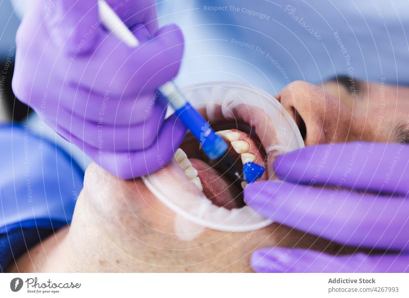 Zahnärztin trägt Fluoridgel auf den Zahn eines Patienten auf Zahnarzt geduldig Leckerbissen Gel bewerben mündlich Gesundheitswesen Mann Klinik Frau Zusammensein