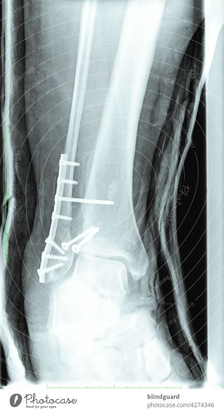 Heavy Metal Röntgenbild Knochen Sprunggelenk Bein Gelenk fixiert Operation Radiologie Skelett WeberB Unfall Fraktur Arzt Gesundheitswesen Krankheit Schrauben
