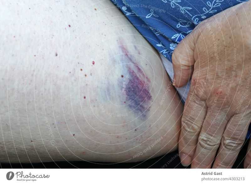 Eine Frau hat an der Schenkelinnenseite eine große schmerzhafte Prellung (blauer Fleck) frau bein schenkel blauer fleck prellung geprellt verletzung wunde