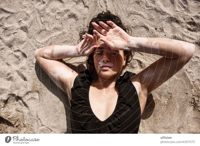 Frau mit Vitiligo-Pigmentfleckenkrankheit liegt in Badekleidung im Sand und schützt sich mit den Händen vor der Sonne Fleck Krankheit Hautpflege versteckt