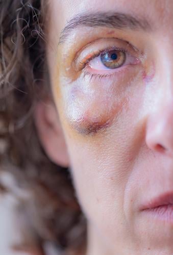 Nahaufnahme einer misshandelten oder missbrauchten Frau mit einem blauen Auge, die nur ein halbes Gesicht zeigt Blaues Auge (Bluterguß) Gewalt