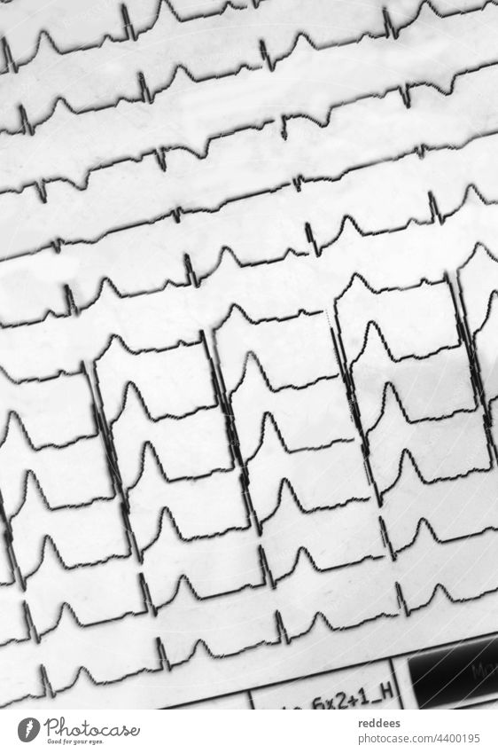 EKG-Anzeige eines Herzfrequenz- oder Pulswellenmessgeräts in einem Krankenhaus Grafische Darstellung Kardiologie Elektrokardiogramm ecg Kardiogramm Pflege