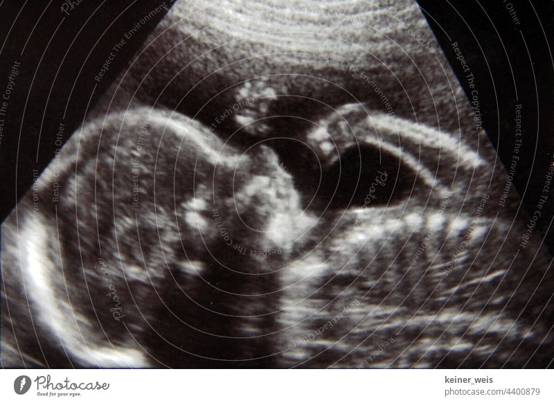 Ultraschallbild eines Embryo oder Sonografie in schwarzweiß Vorsorgeuntersuchung Baby pränatal Kind schwanger Bauch Kinderwunsch Babybauch Vorfreude